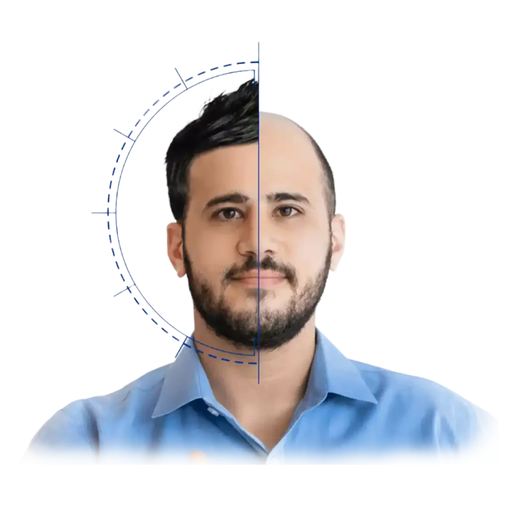 before after - Hair Transplant UAE