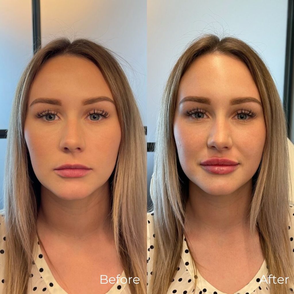 lip-filler-before-and-after-bossgalbeautybar-oh-1024x1024
